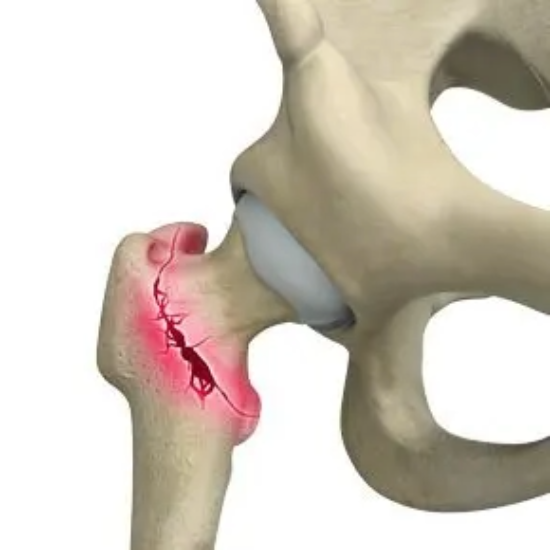 Managing hip fractures