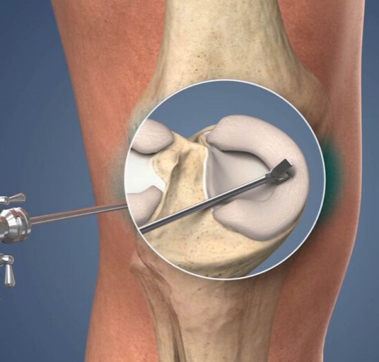 Arthroscopic Knee Surgery